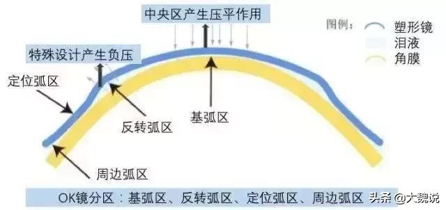 近视最新进展重塑视界，激发无限可能的科技突破！